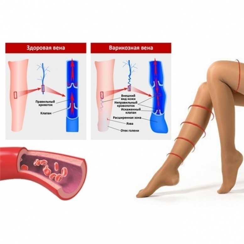 Чулки Для Ног От Варикоза